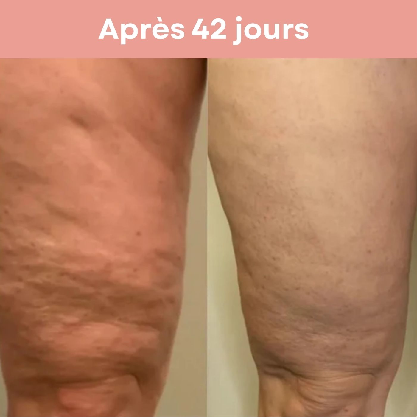 Appareil de Massage Anti-Cellulite BEAUTIFERA 3 en 1